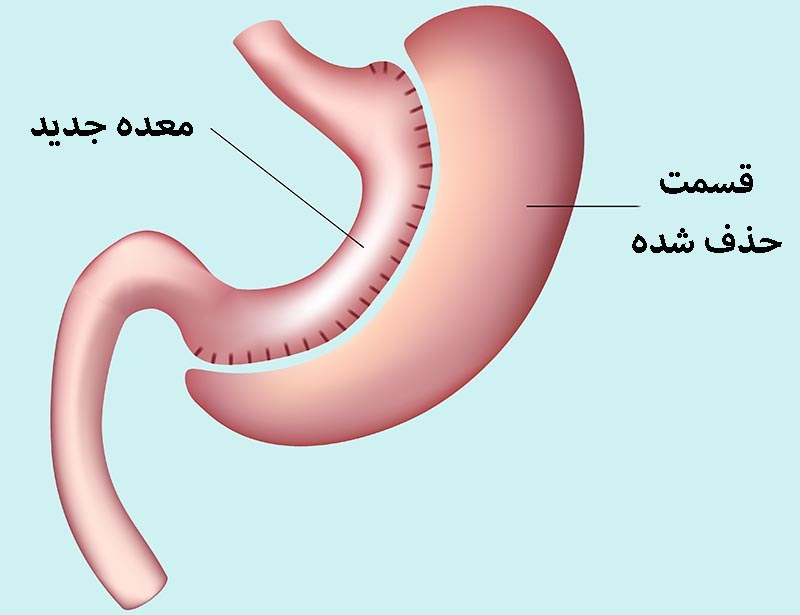 اسلیو معده